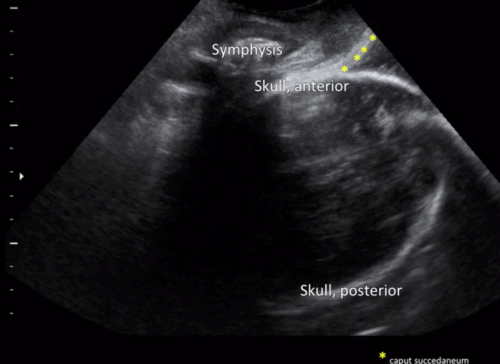 Isuog Practice Guidelines Intrapartum Ultrasound