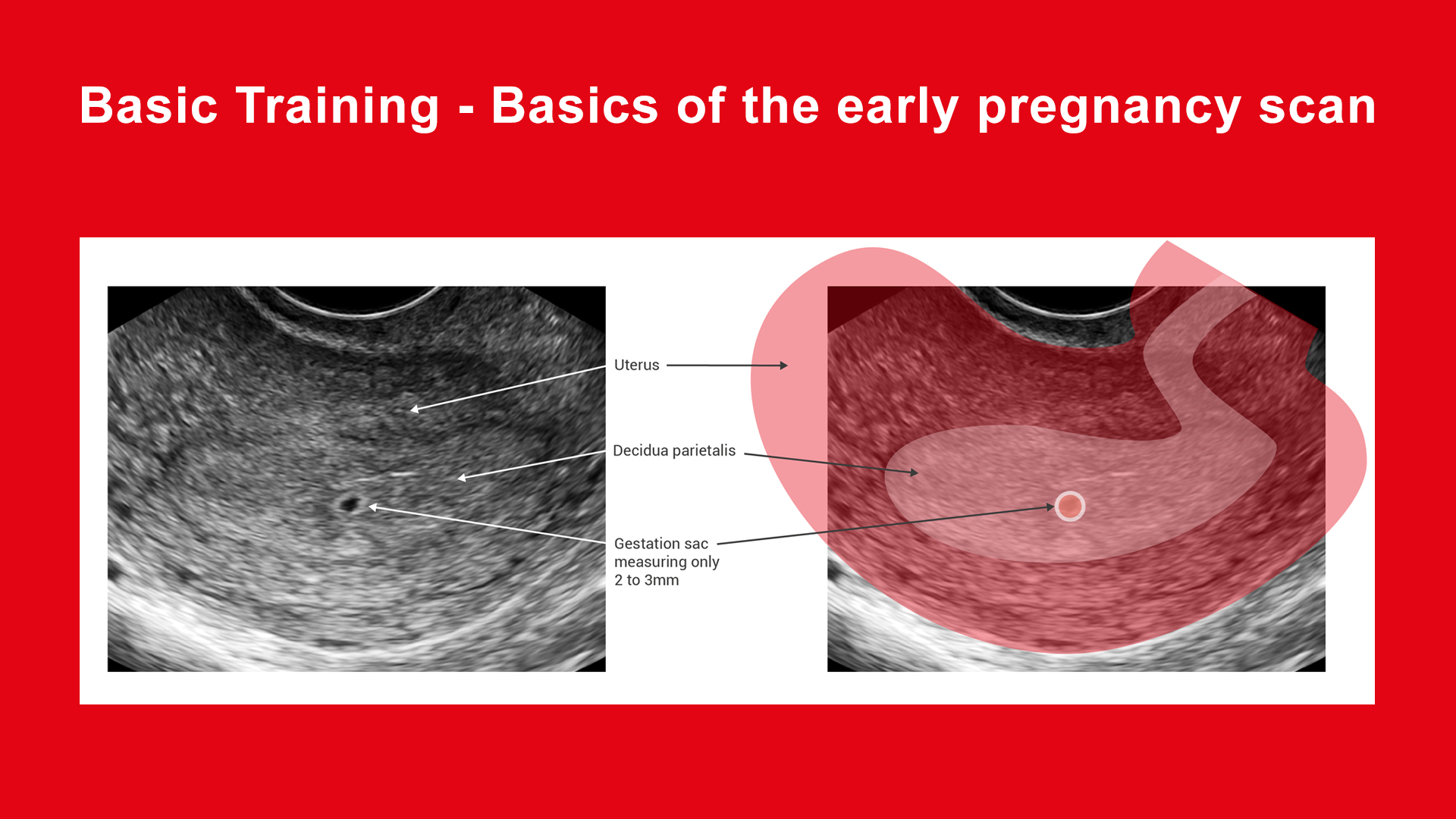 Basics of the early pregnancy scan