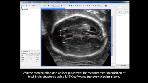 UOG video clip: International standards for fetal brain structures ...