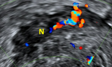 Endometriosis-doppler-cropped.png