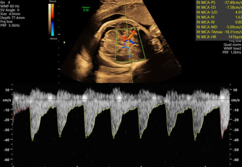 Newly updated ISUOG Practice Guidelines: use of Doppler velocimetry in ...