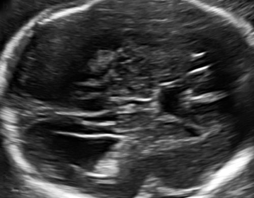 Supplement Your Learning For Our Advanced Fetal Neurosonography Course