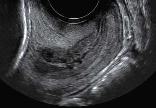 Bowel Preparation Prior To Transvaginal Ultrasound Improves Detection Of Rectosigmoid Deep