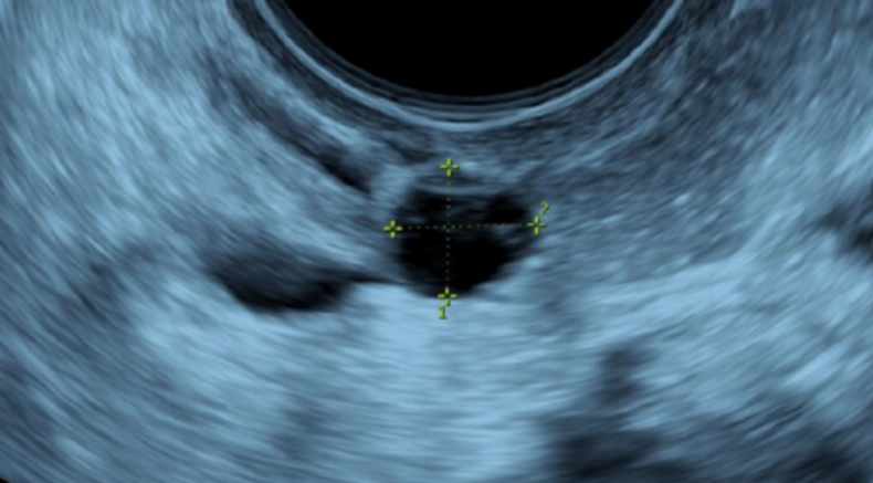 Imaging-in-gyne-disease-ultrasound-cyst.png