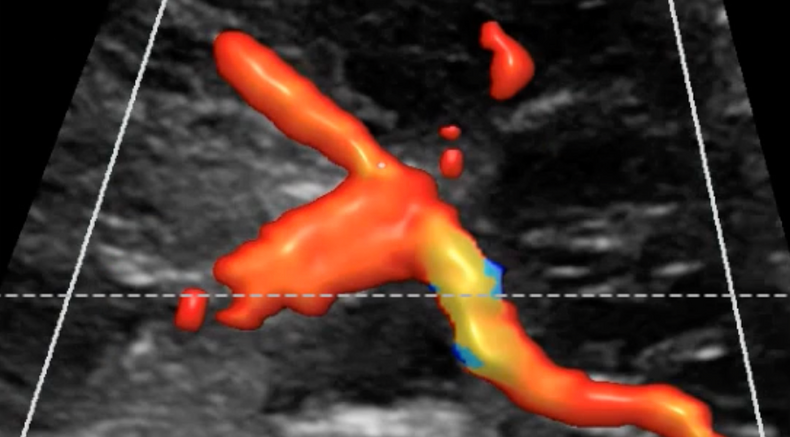 Visuog Doppler assessment of the uterine arteries 1.png