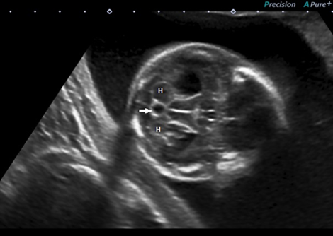 Acquired ear abnormalities