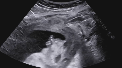 Heterotopic Pregnancy