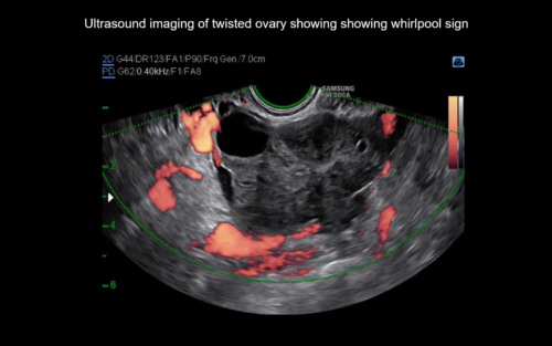 Uog Video Clip Imaging In Gynecological Disease 20 Clinical And Ultrasound Characteristics