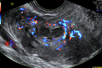 uterus fibroids ultrasound