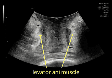 UOG videoclip: Measurement of transverse diameter of levator ani muscle ...