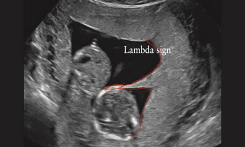 VISUOG chapter on Doppler assessment in twin pregnancies is now open