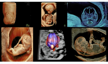 ISUOG International First Trimester Symposium 2025.png