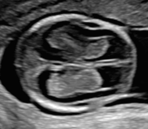 Newly Updated Isuog Practice Guidelines Sonographic Examination Of The Fetal Central Nervous 