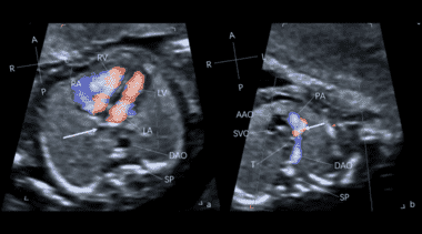 UOG videoclip: Novel marker for diagnosis of supracardiac total ...