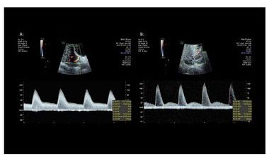 preeclampsia.jpg