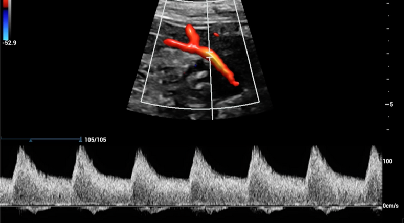 Visuog Doppler assessment of the uterine arteries 2.png