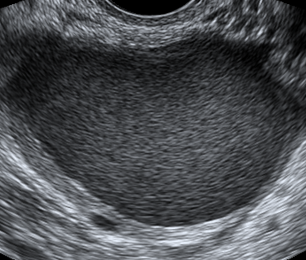 Ultrasound in assessment of endometriosis and adenomyosis