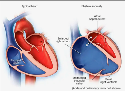 Ebstein’s anomaly