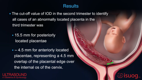 uog-video-abstract-follow-up-ultrasound-in-second-trimester-low