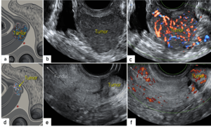 Advanced Cancer Course Helps Clinicians Leverage Ultrasound Effectively