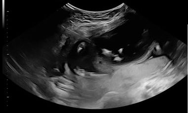 Fetal sampling techniques.jpg