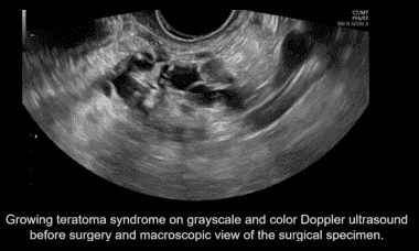 UOG videoclip: Growing teratoma syndrome after treatment of ovarian ...