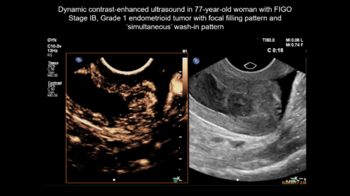 UOG video clip: Dynamic contrast‐enhanced ultrasound improves ...