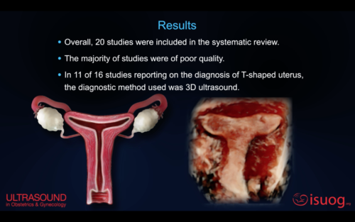 Uog Video Abstract Definitions Prevalence Clinical Implications And Treatment Of T Shaped Uterus Systematic Review