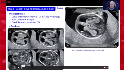 Detecting abnormalities on a scan in the first trimester