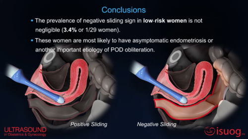 uog-video-abstract-prevalence-of-negative-sliding-sign-representing