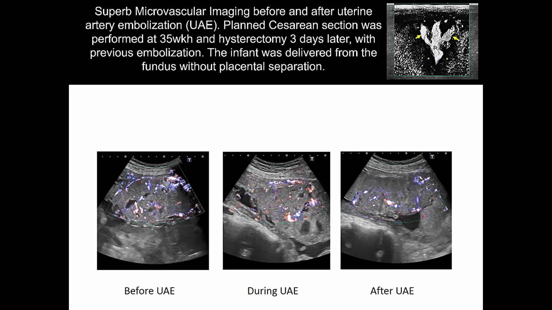 uog-video-clip-diagnosis-of-placenta-accreta-spectrum-using-ultra-high