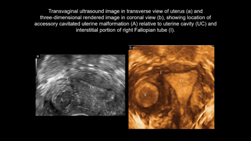 UOG Videoclip: Clinical And Ultrasound Characteristics Of Accessory ...