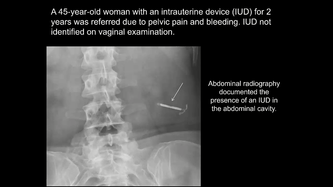 UOG video clip: intraoperative ultrasound assistance for surgical ...